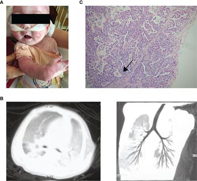 A Novel STAT3 Gain-of-Function Mutation in Fatal Infancy-Onset Interstitial Lung Disease